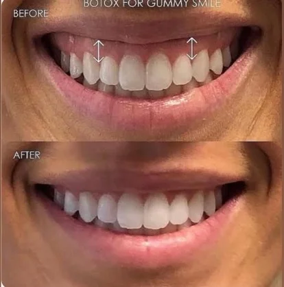 Dental before and after smile result