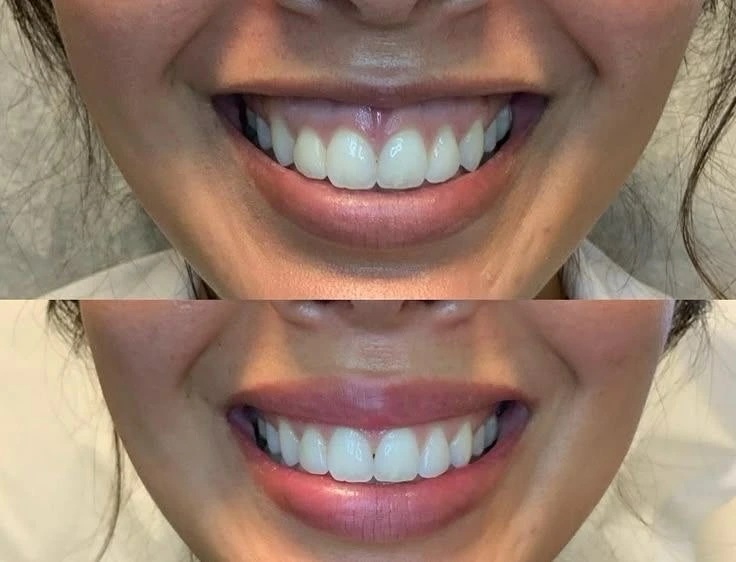 Smile before and after dental result