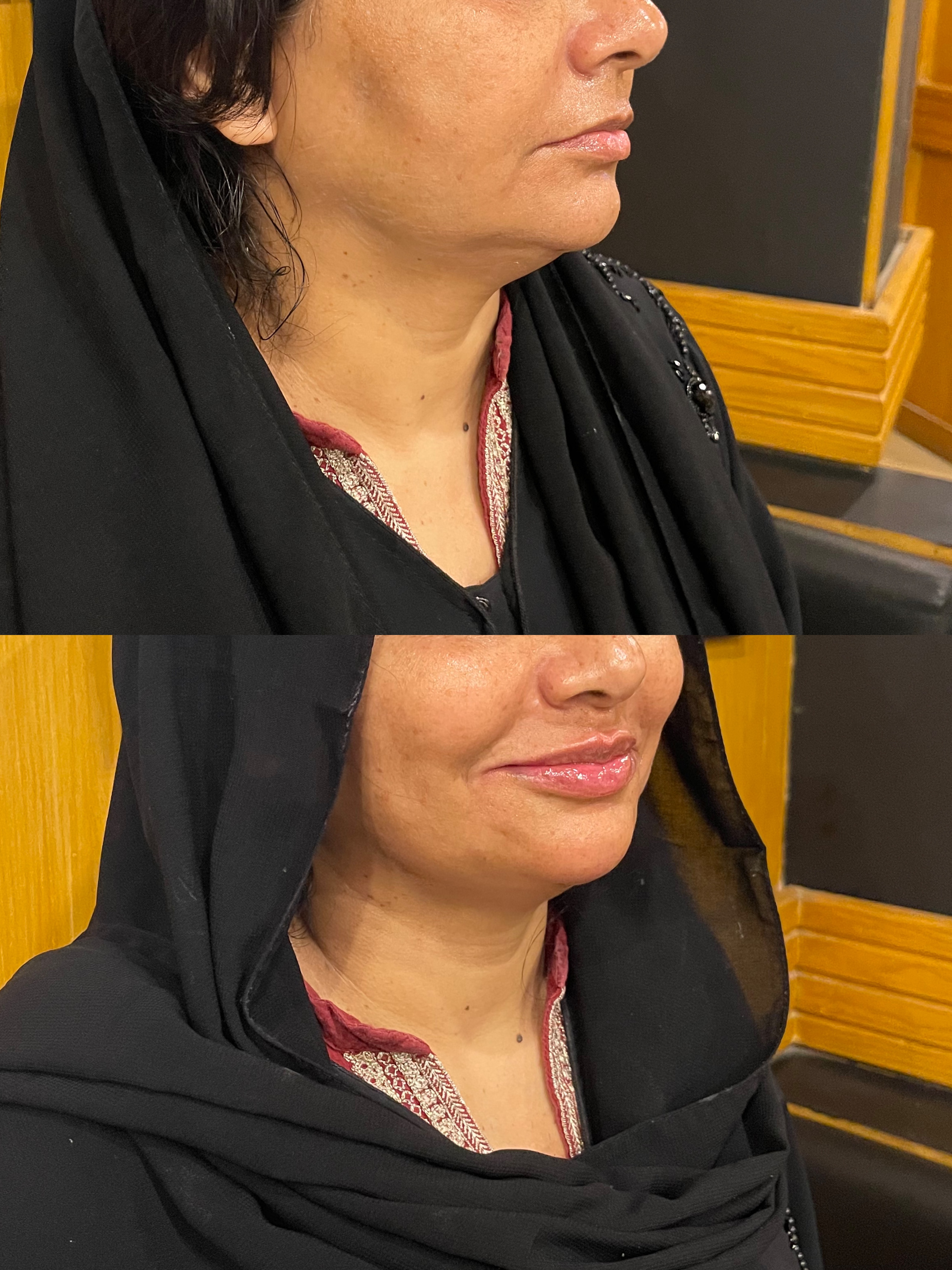 Facial aesthetic treatment before and after result