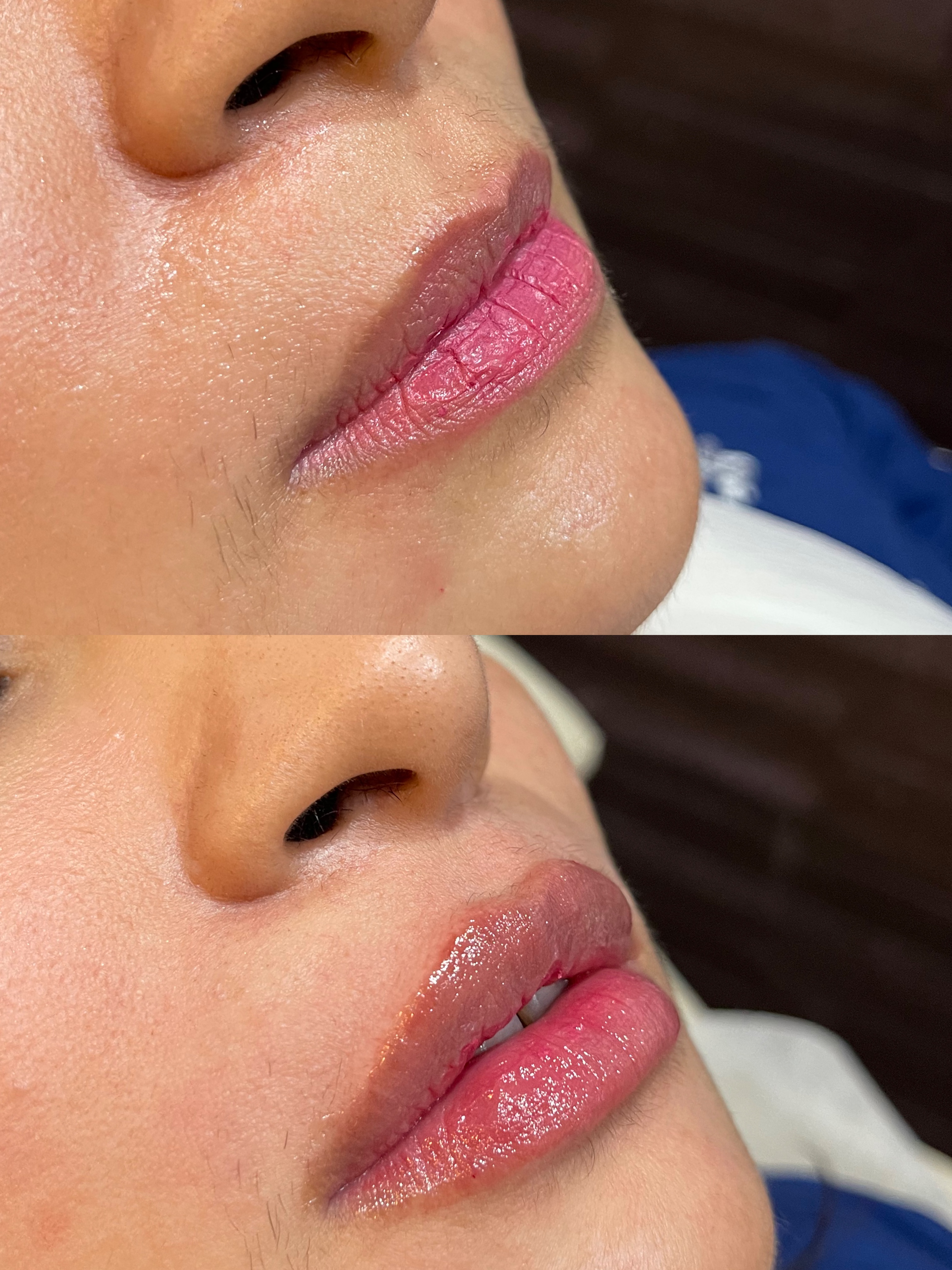Botox or dermal filler before and after result