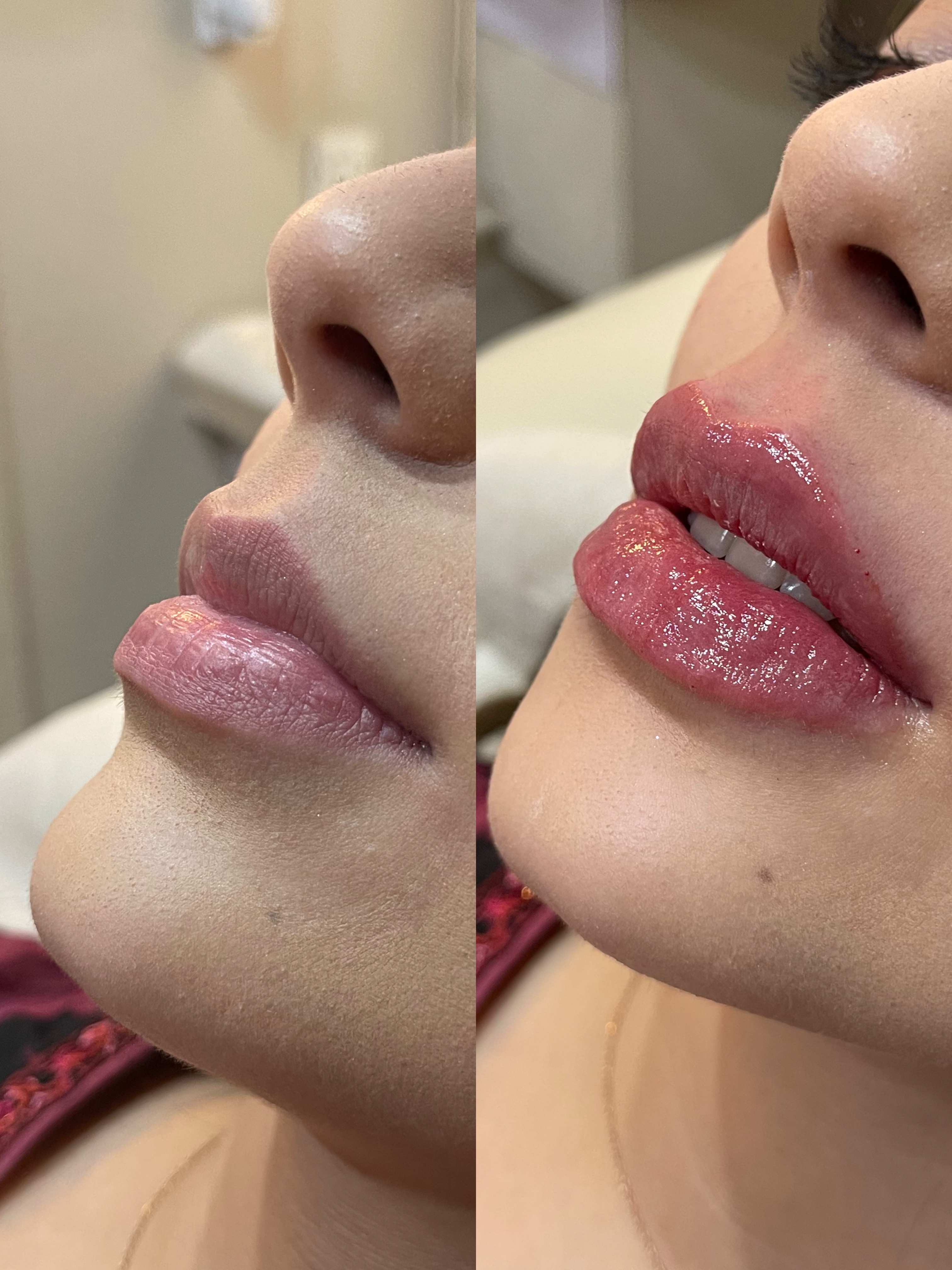 Botox and filler patient result