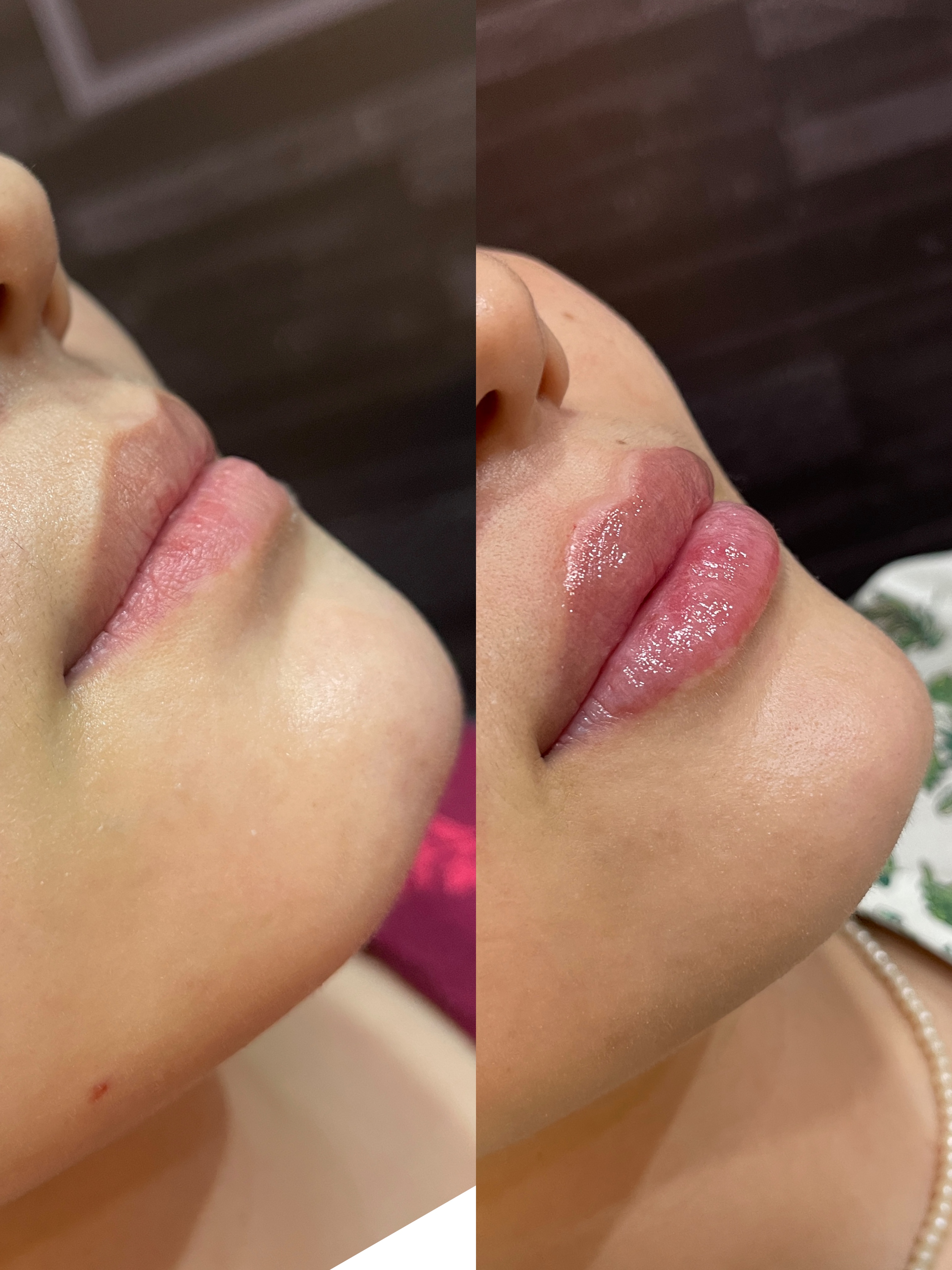 Injectable facial enhancement patient result