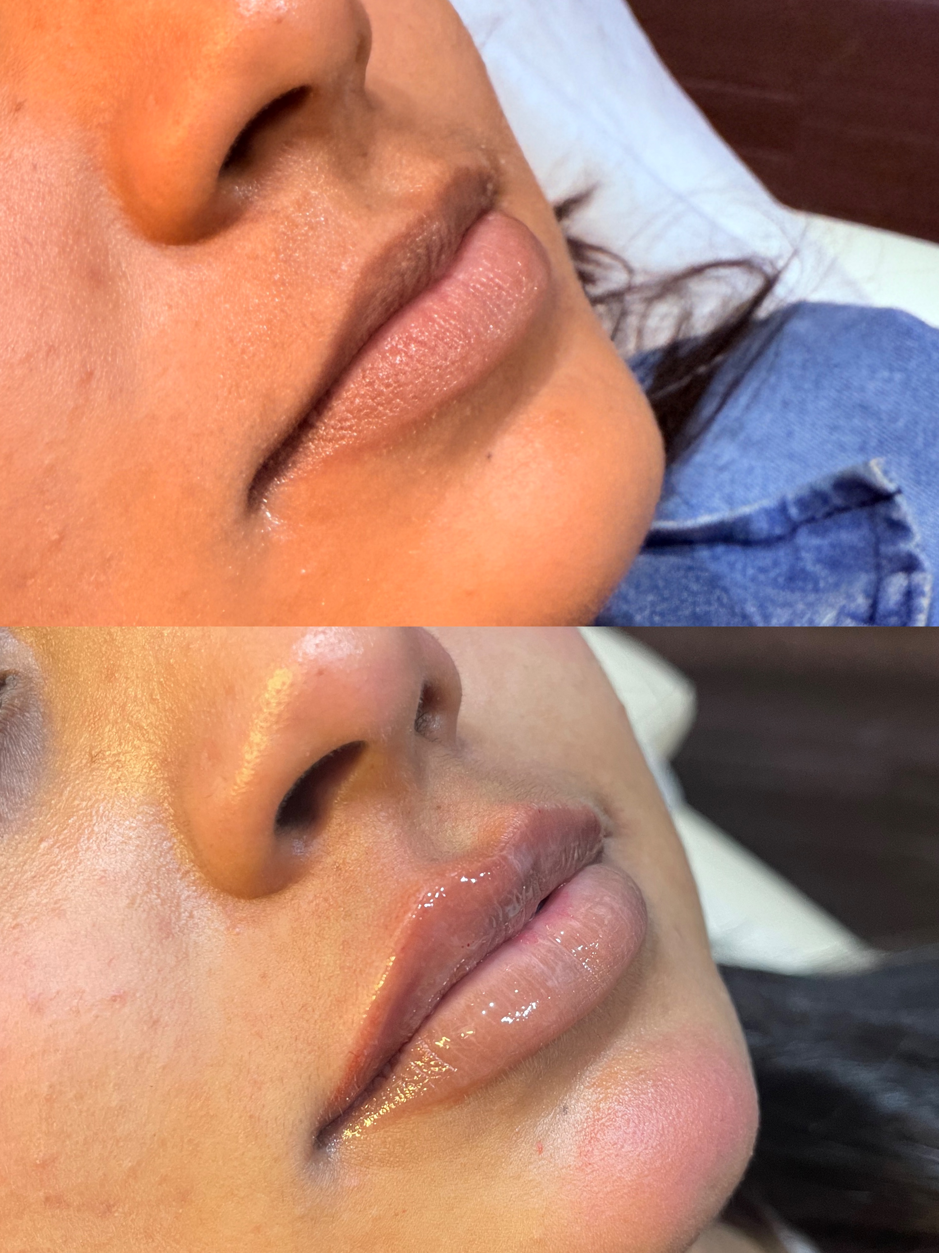Aesthetic treatment before and after patient result