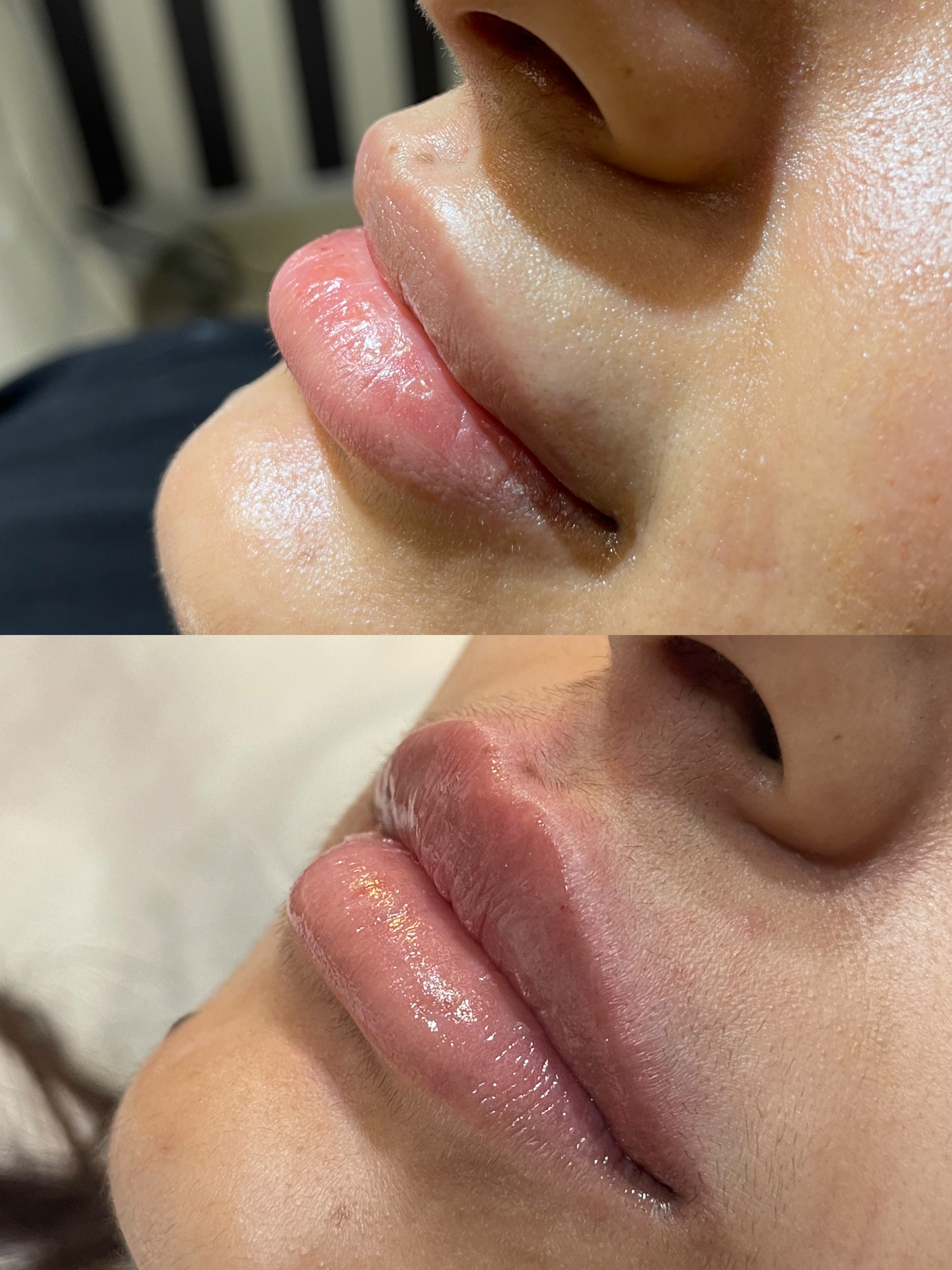 Natural looking injectable treatment result