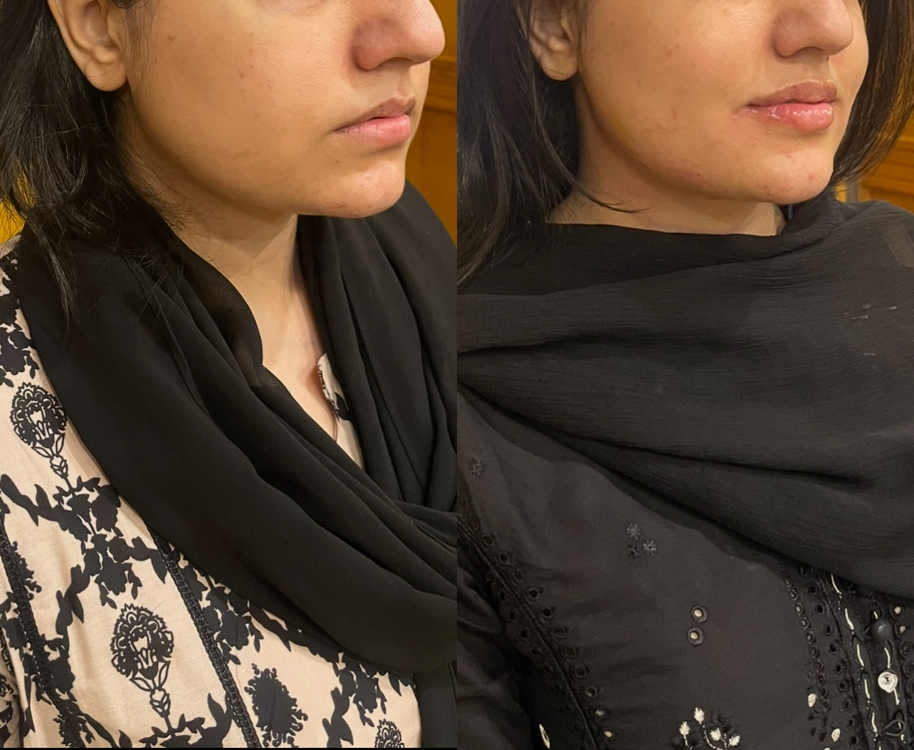 Dermal filler patient before and after result