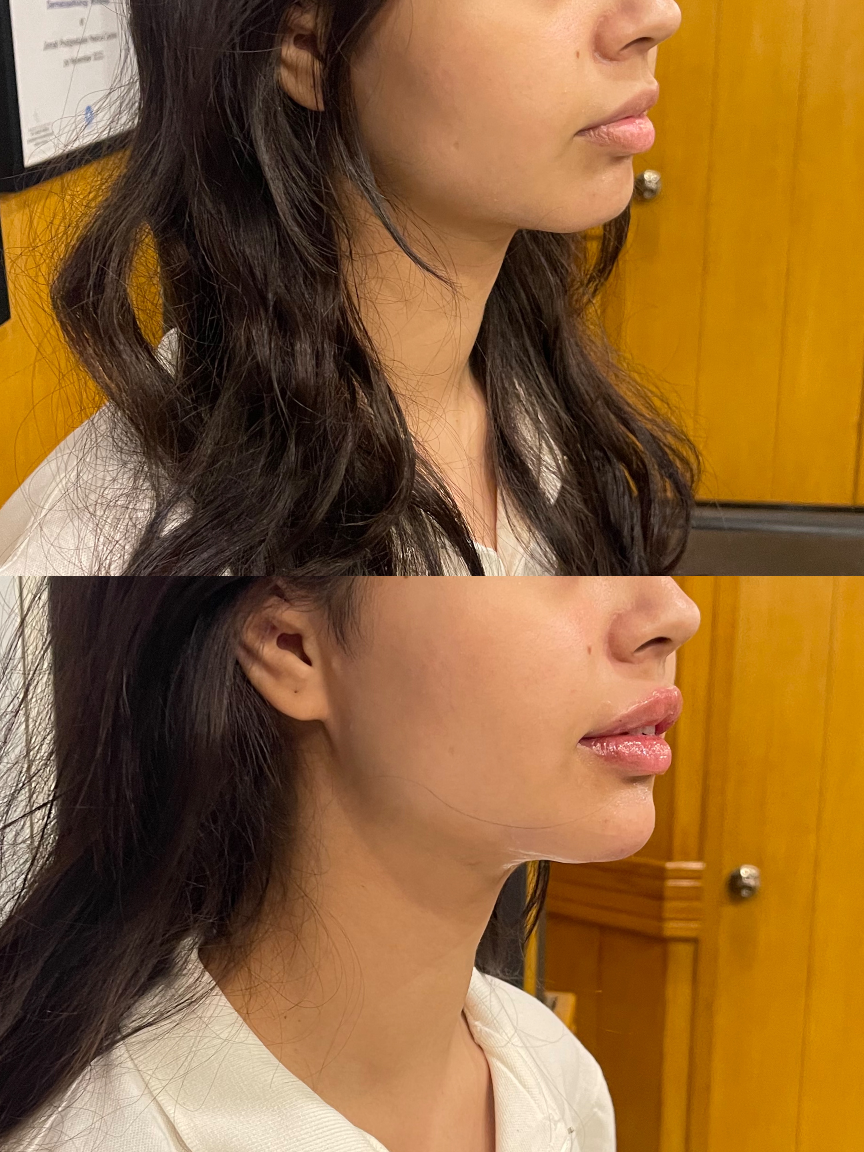 Aesthetic injectable before and after result