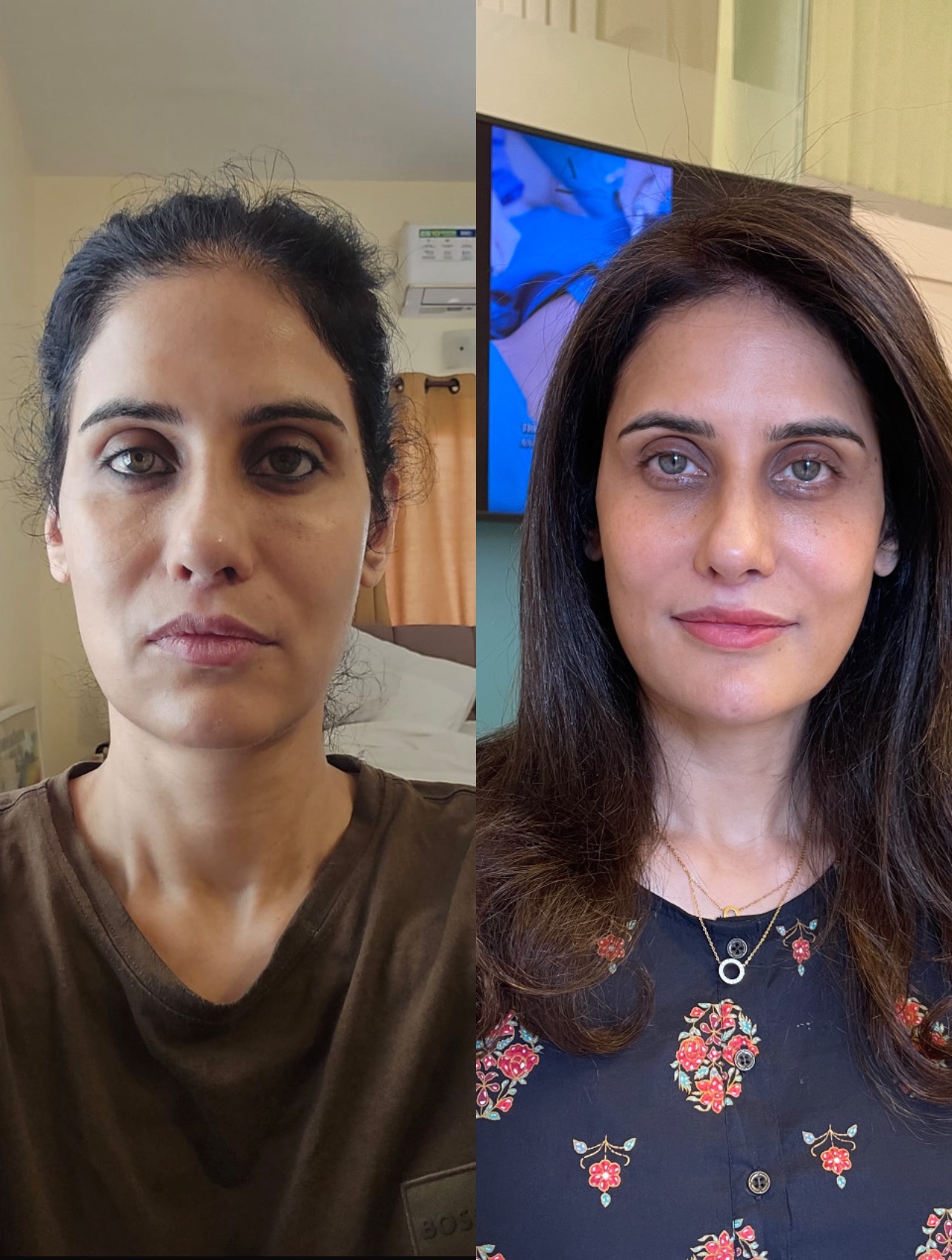 Injectable treatment before and after result