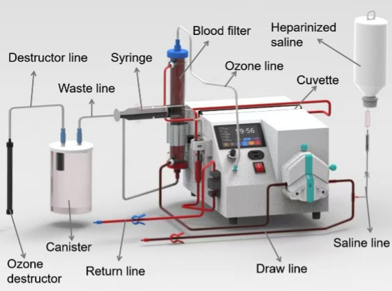 EBOO vs EBO2 ozone therapy machine comparison showing the technical layout of an extracorporeal blood oxygenation device. EBOO vs EBO2 ozone therapy machine comparison showing the technical layout of an extracorporeal blood oxygenation device.