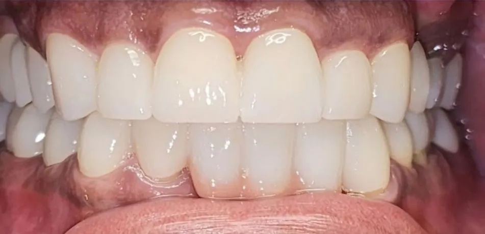 Full mouth reconstruction result by Dr. Zhang at A to Z Magic Dental