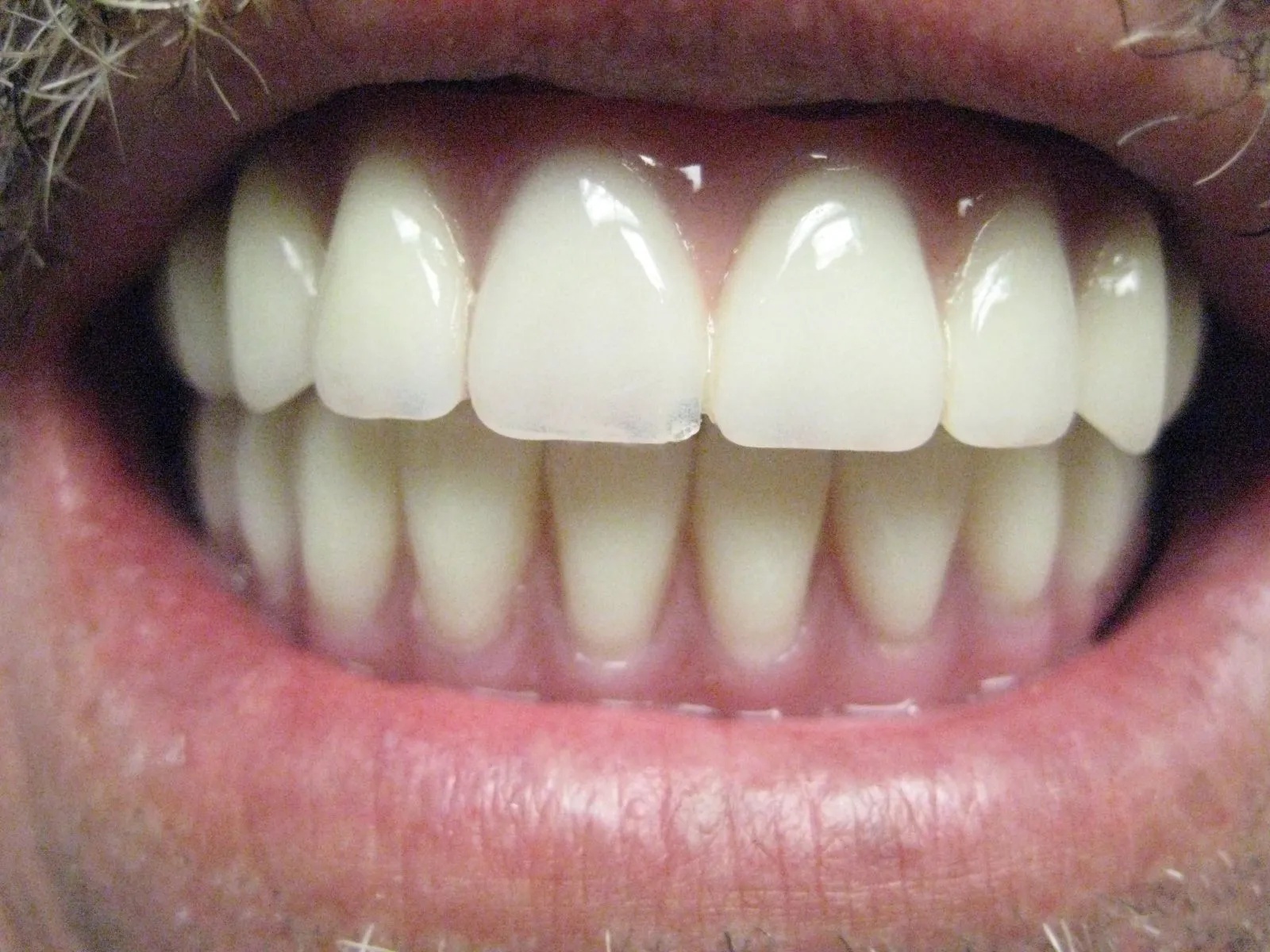 Dental implants result by Dr. Zhang at A to Z Magic Dental