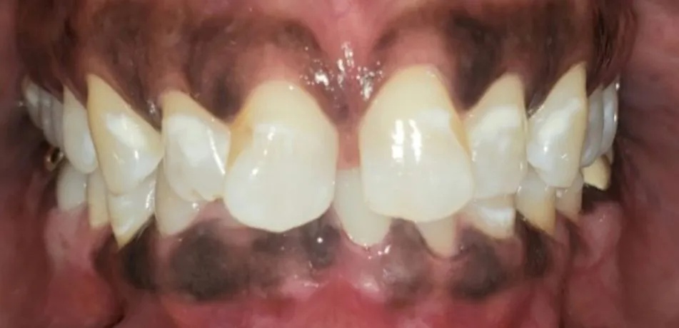 Fastbraces and crowns before