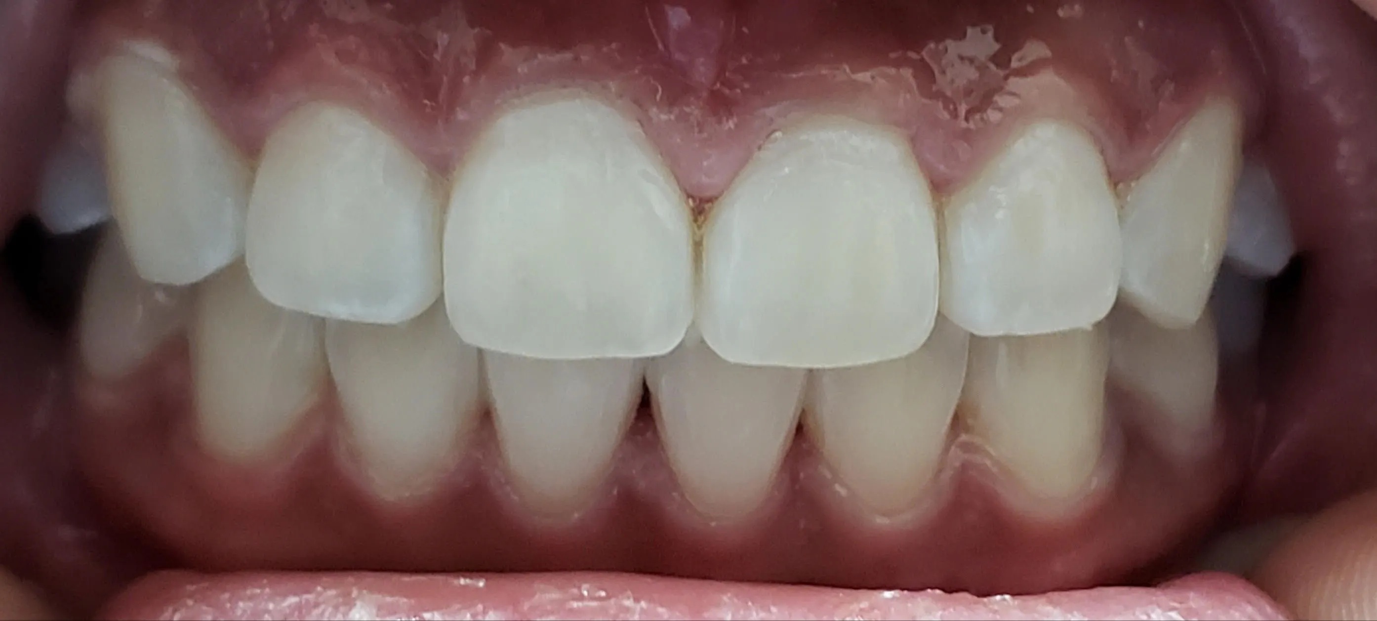 Teeth whitening after