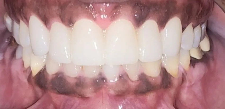 Fastbraces and crowns after