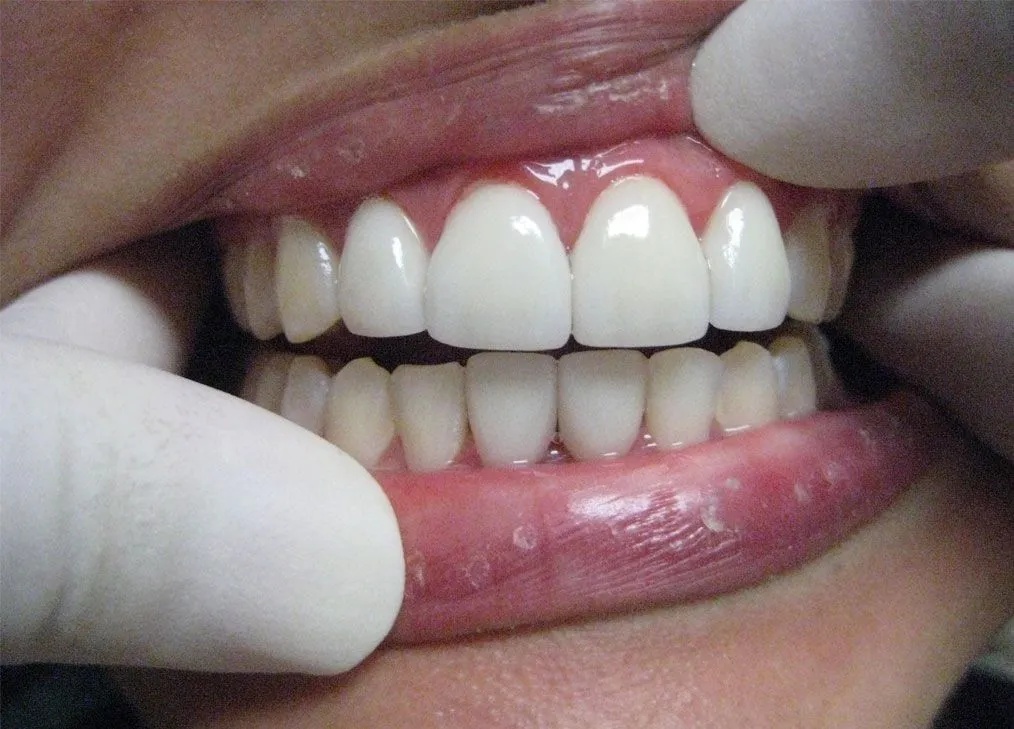 Veneers after