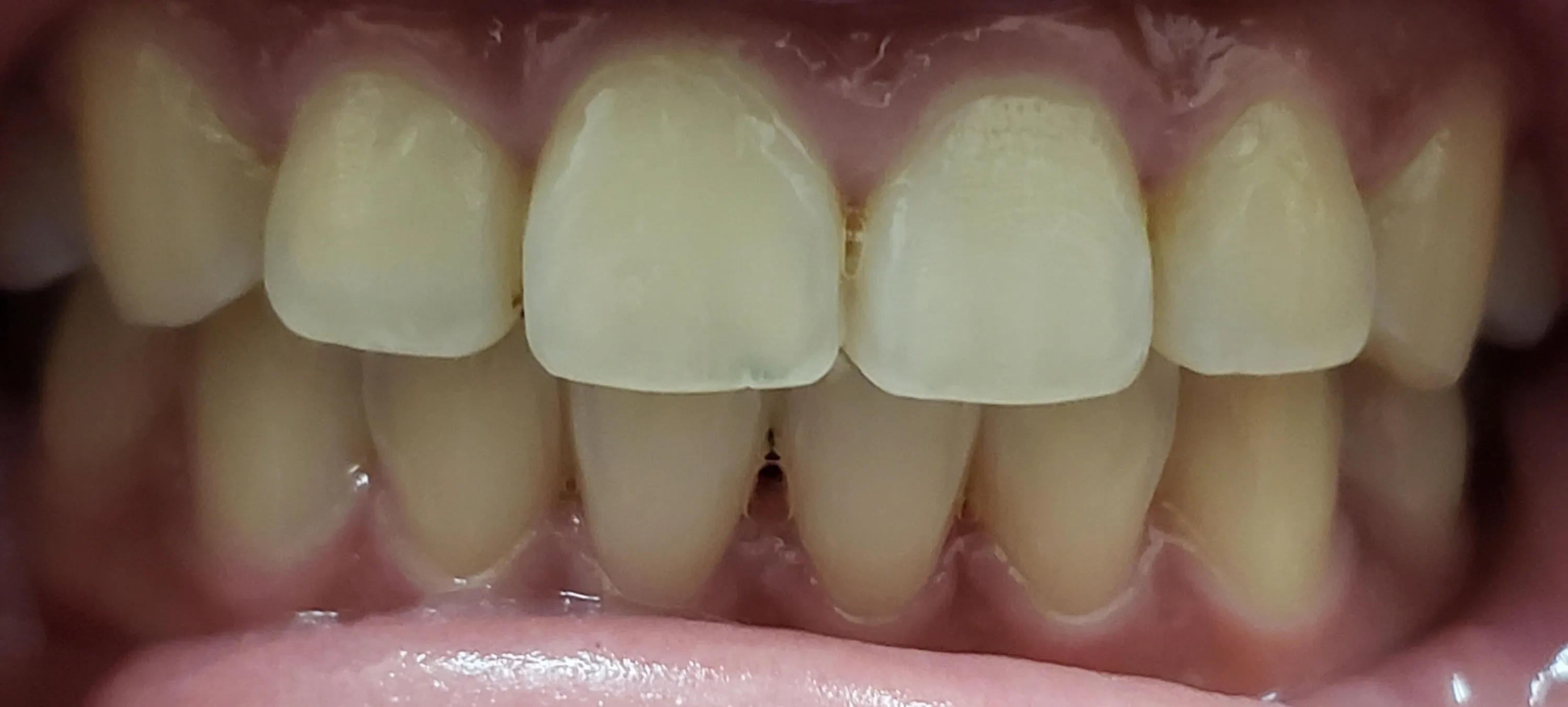 Teeth whitening before