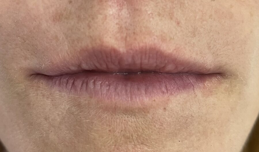 Before treatment, Amelia Clinic