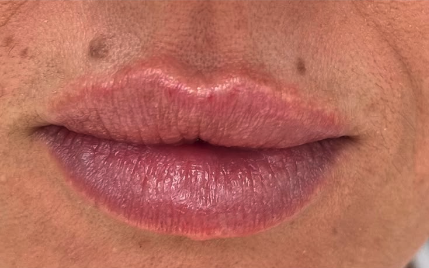 Lip treatment result, Amelia Clinic, Užice