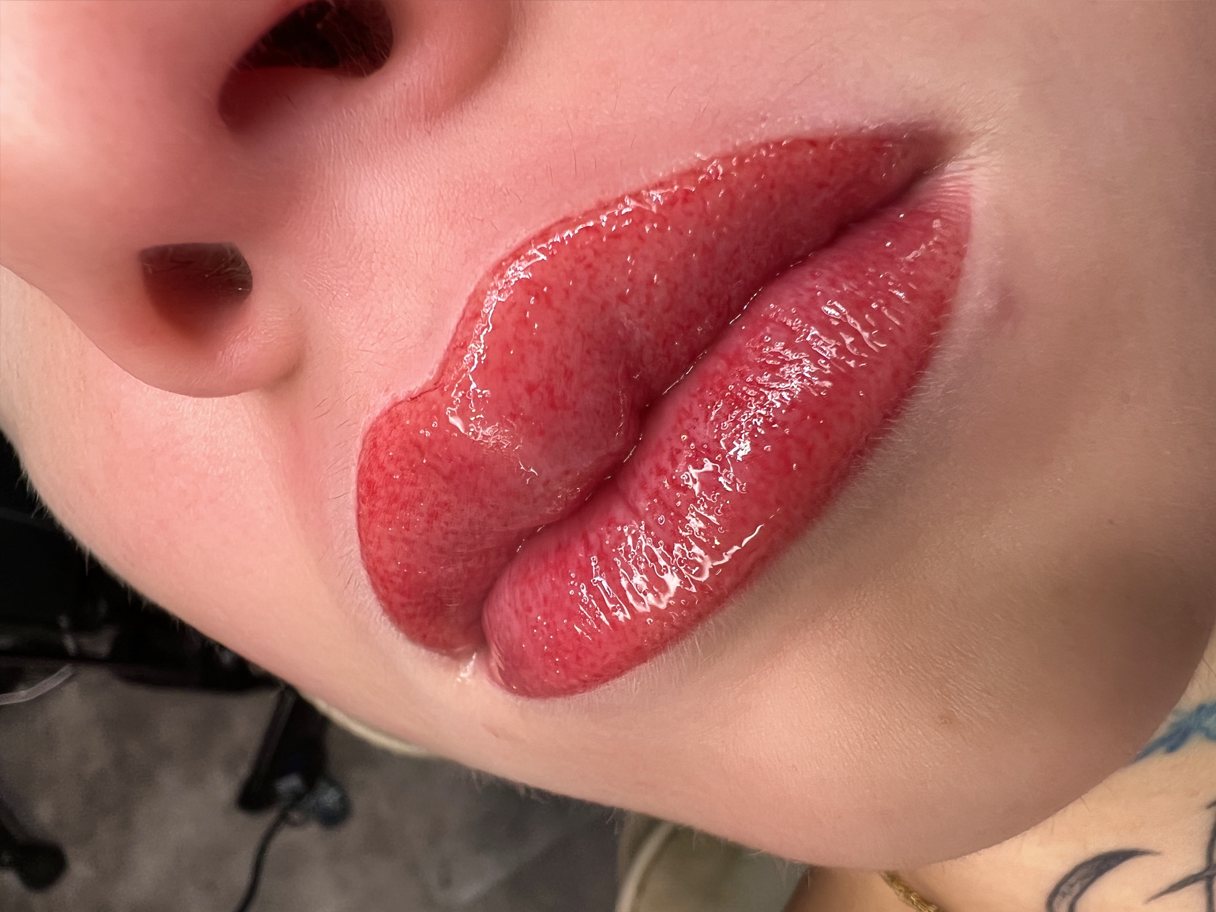 Lips healed result