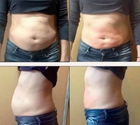 is glp 1 better than metformin TrimRX