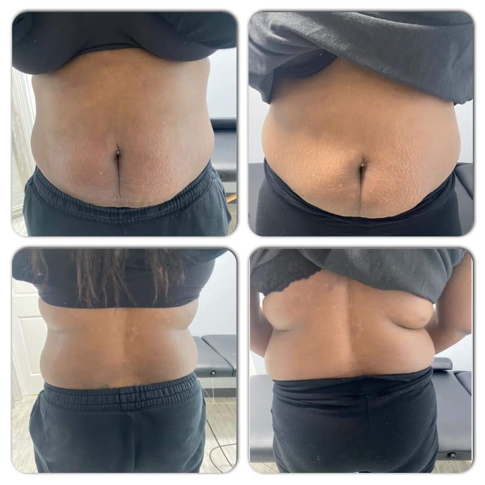 injecting tirzepatide above belly button Don't inject too close to your belly button : r/Zepbound