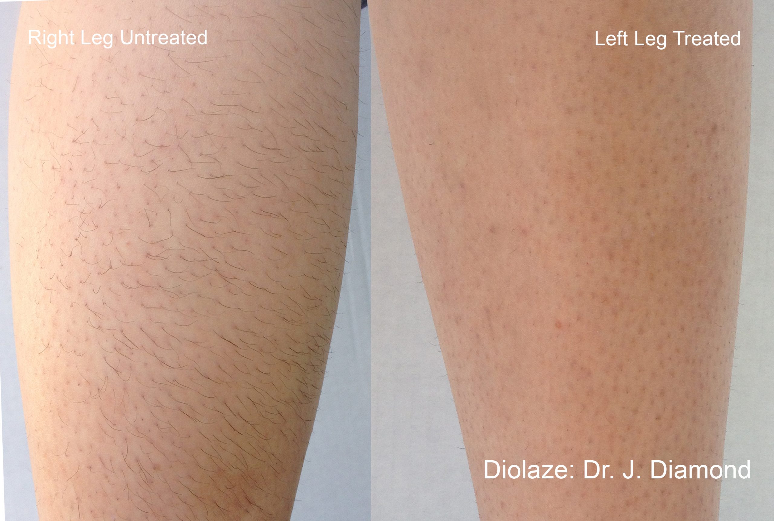 Diolaze laser hair removal before and after leg hair reduction