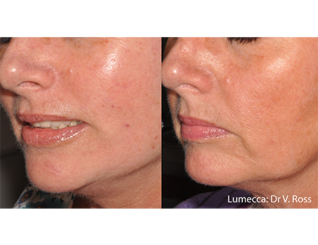 Lumecca IPL before and after for facial sun damage