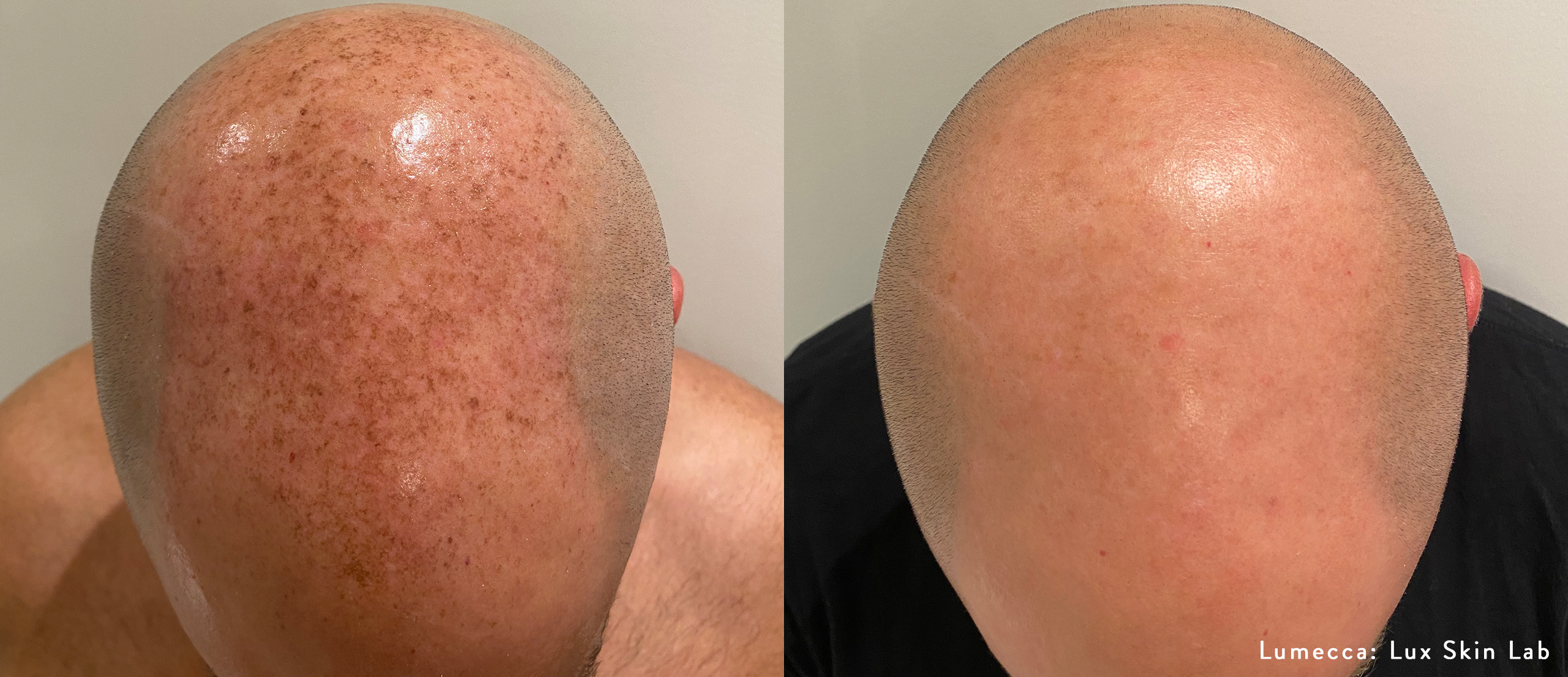 Lumecca IPL before and after for sun spots