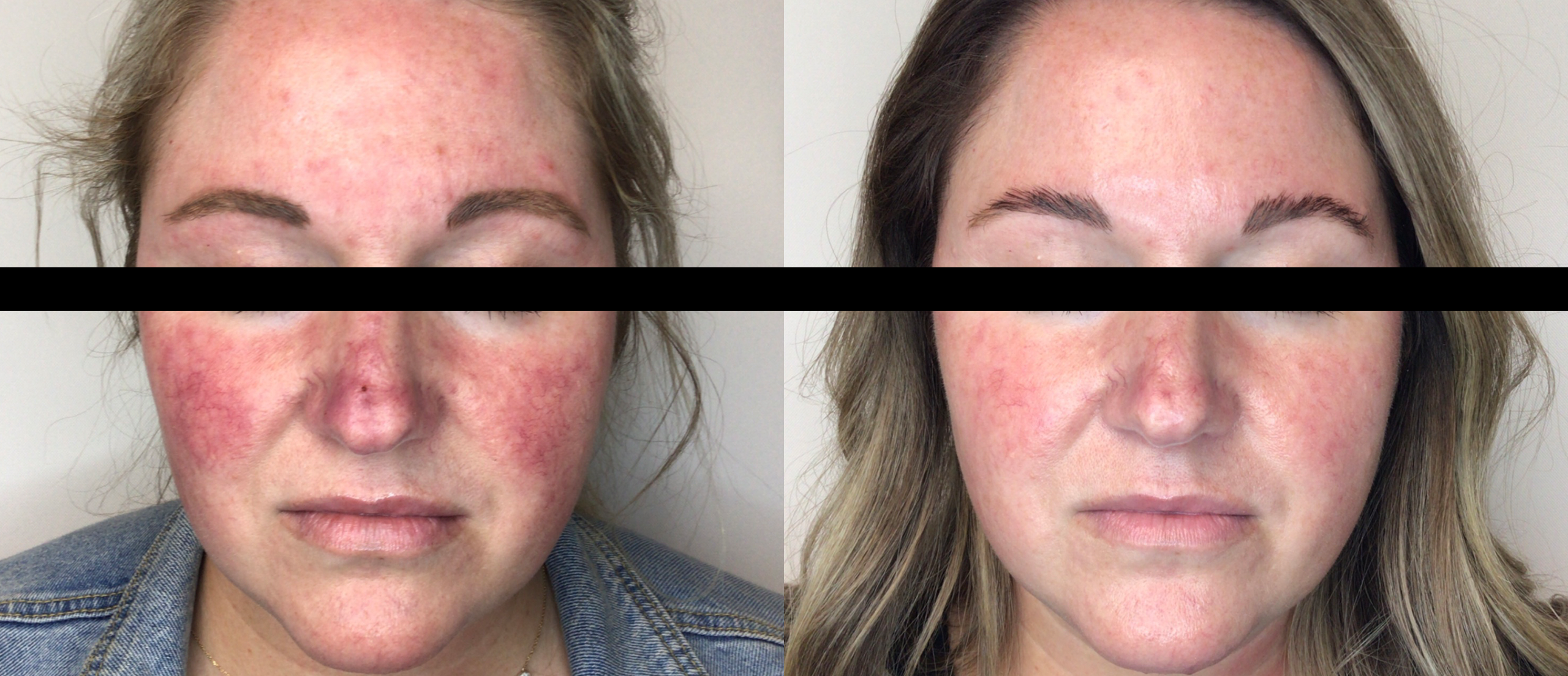 Lumecca IPL before and after for redness