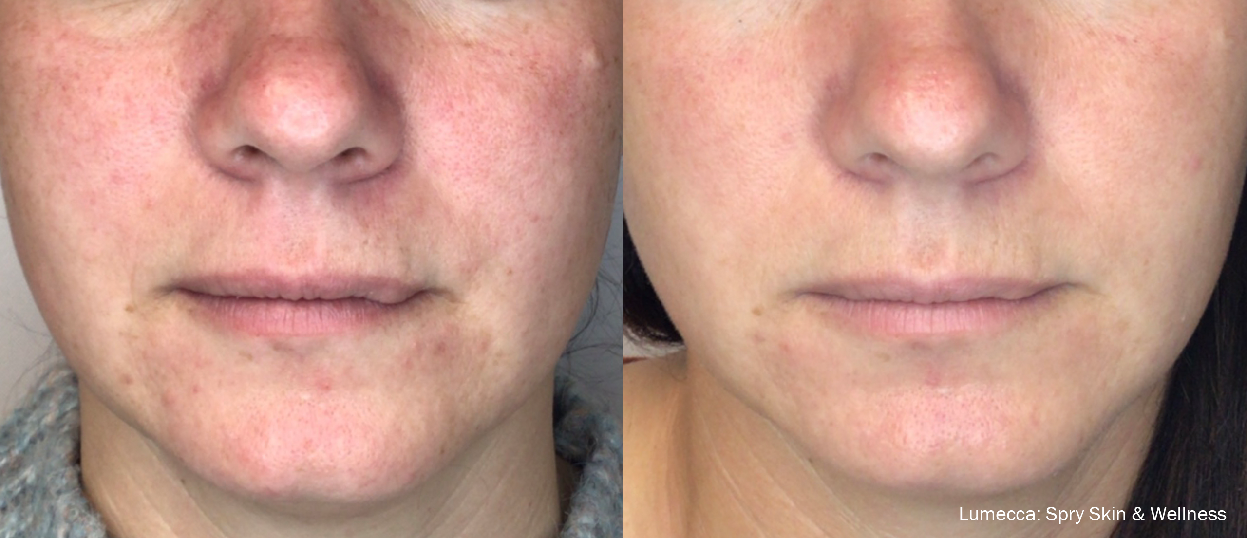 Lumecca IPL before and after for uneven tone