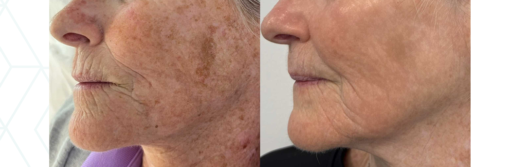 Lumecca IPL before and after for facial pigmentation