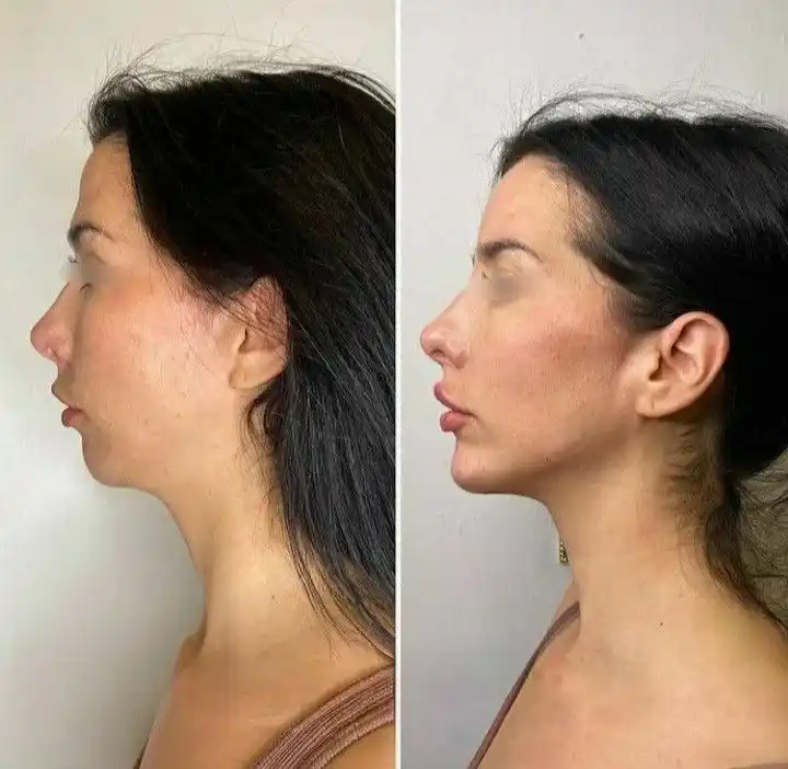 Antes y después real de paciente, Full Face