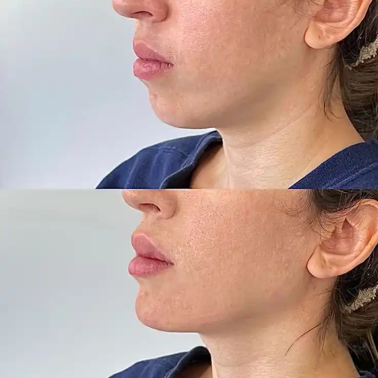 Antes y después real de paciente, Full Face
