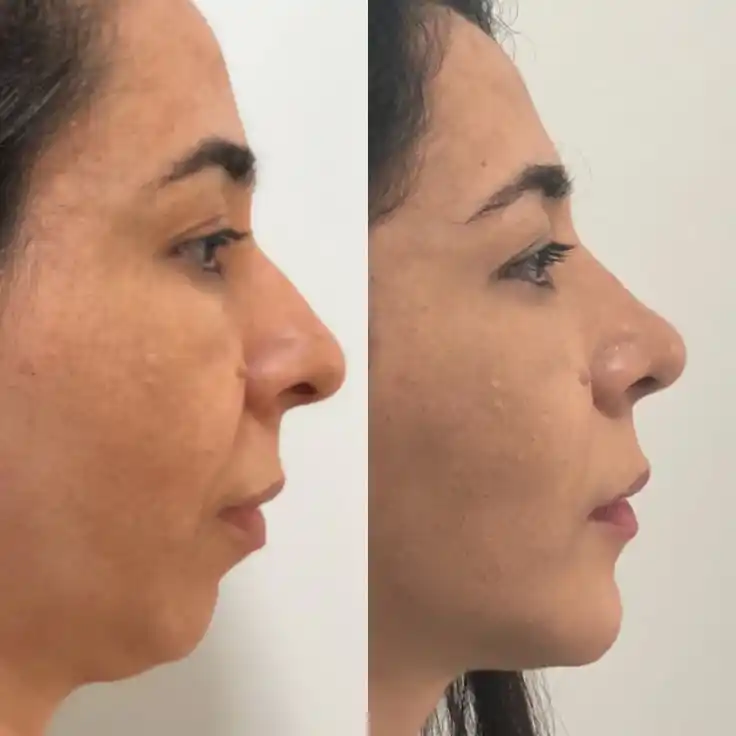 Antes y después real de paciente, Full Face