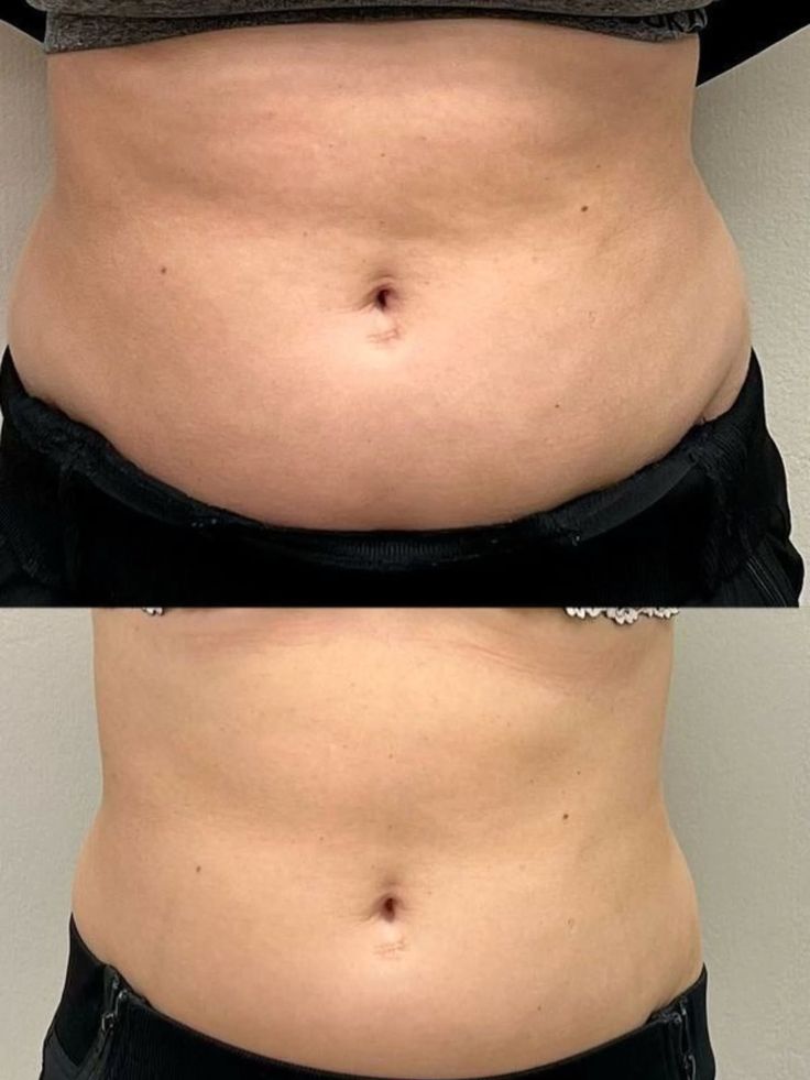 Résultat Amincissement