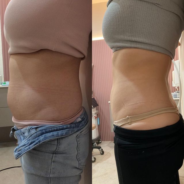 Résultat Amincissement