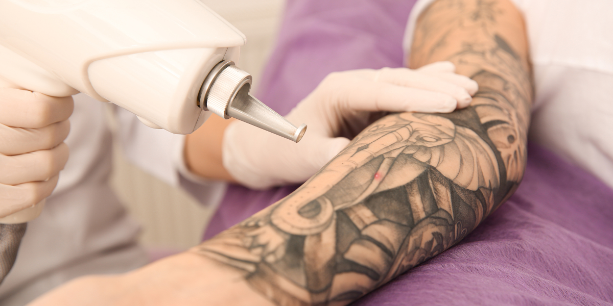 Tattoo sleeve getting removed with laser treatment