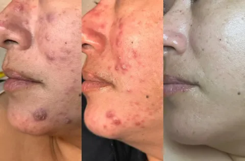 Three stages of one client's acne treatment progress, from raised inflamed breakouts to clear, even skin