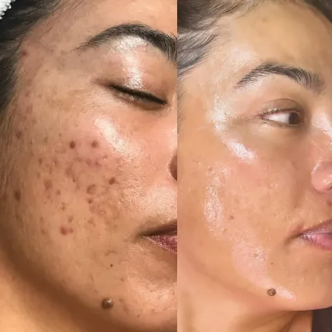 A client's cheek before and after the Clear Skin Program, with breakouts and dark marks visibly reduced