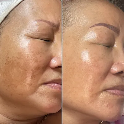Before and after: broad patches of brown discoloration across the cheek, then visibly lighter, more even tone with a soft natural glow.