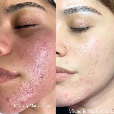 Before and after: a cheek covered in inflamed breakouts and deep redness, then noticeably calmer, more even skin with far fewer active blemishes.