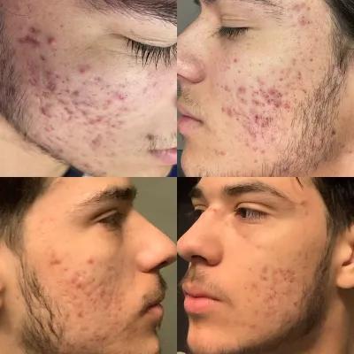 Before and after: both cheeks densely covered in inflamed breakouts, then calm skin with only faint remaining marks.