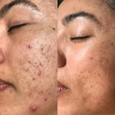 Before and after: dark spots and raised blemishes across the cheek, then clearer, smoother skin with the marks substantially faded.