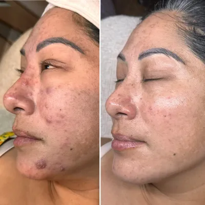 Before and after: congested, bumpy skin with raised blemishes along the cheek and jaw, then smooth, settled skin.