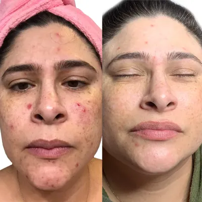 Before and after: red, inflamed spots across the forehead, cheeks and chin, then clear, even-toned skin.