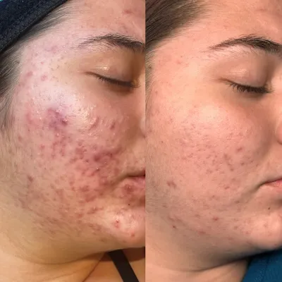Before and after: deep inflamed breakouts across the cheek and jawline, then markedly calmer skin with the marks fading.