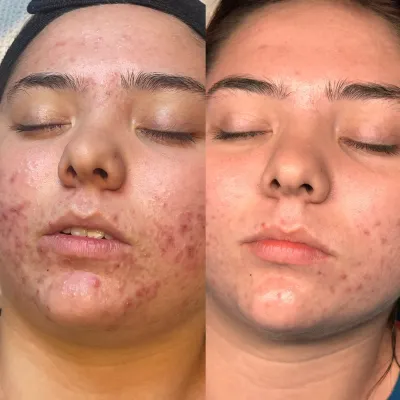 Before and after: widespread red breakouts across the cheeks and chin, then largely clear, even skin.