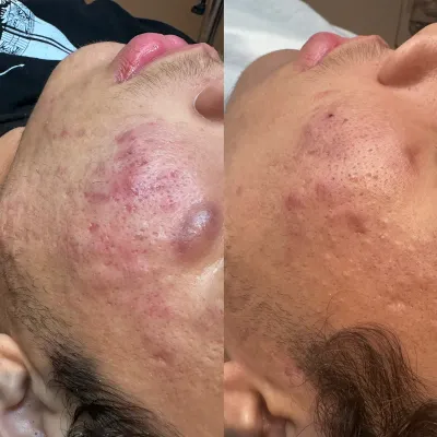 Before and after: a raised, inflamed cluster along the temple and cheek, then flattened, calmed skin.