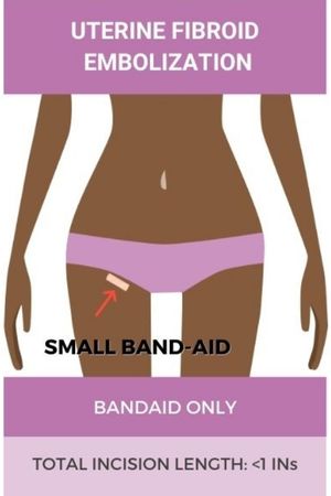 The incision after UFE is shorter than an inch and can be covered with a band-aid.