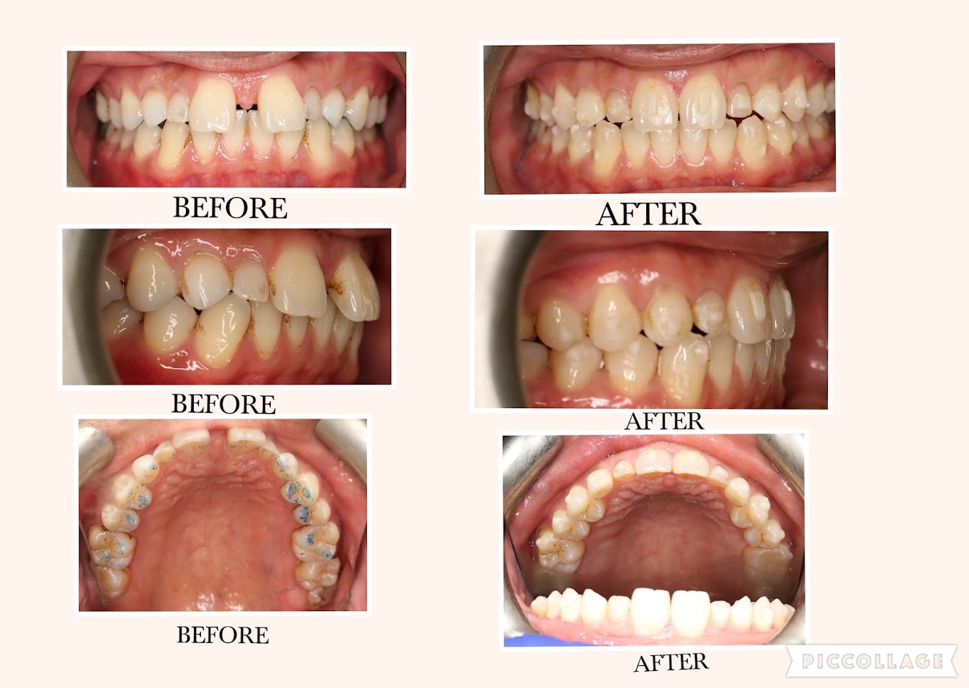 BrightRay Dental Invisalign before and after smile gallery