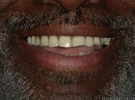 Patient smile, before